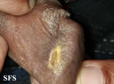 candidiasis