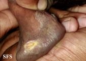 candidiasis