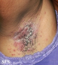 candidiasis