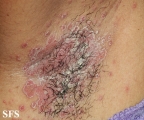 candidiasis