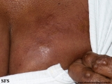 rheumatoid_arthritis