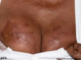 rheumatoid_arthritis