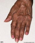 rheumatoid_arthritis