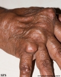 rheumatoid_arthritis