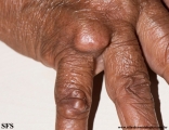 rheumatoid_arthritis