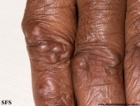 rheumatoid_arthritis