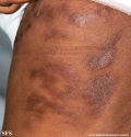 rheumatoid_arthritis