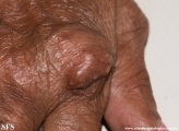 rheumatoid_arthritis