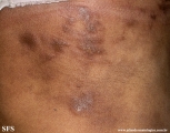 rheumatoid_arthritis