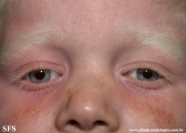 albinism