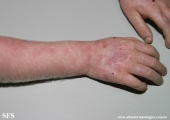 albinism