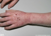 albinism