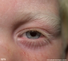 albinism