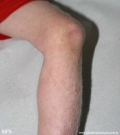 albinism