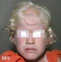 albinism