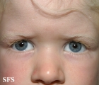 albinism