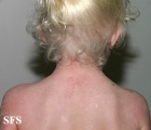 albinism