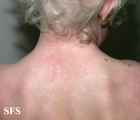 albinism