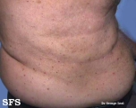 grover's disease