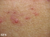 grover's disease