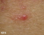 grover's disease