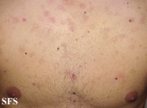 eosinophilic pustular folliculitis