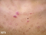 eosinophilic pustular folliculitis