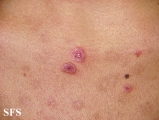 eosinophilic pustular folliculitis