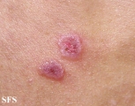 eosinophilic pustular folliculitis