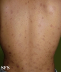 eosinophilic pustular folliculitis