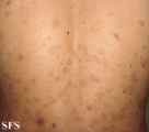 eosinophilic pustular folliculitis