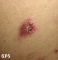 eosinophilic pustular folliculitis