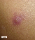 eosinophilic pustular folliculitis