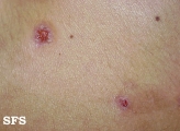 eosinophilic pustular folliculitis