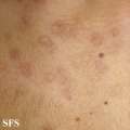 eosinophilic pustular folliculitis