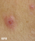 eosinophilic pustular folliculitis