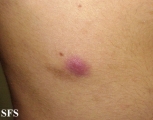 eosinophilic pustular folliculitis