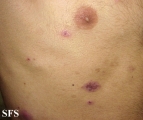 eosinophilic pustular folliculitis