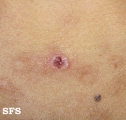 eosinophilic pustular folliculitis