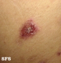 eosinophilic pustular folliculitis