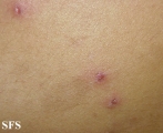eosinophilic pustular folliculitis