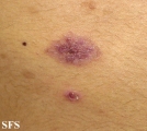 eosinophilic pustular folliculitis
