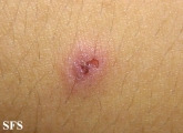 eosinophilic pustular folliculitis