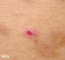 eosinophilic pustular folliculitis