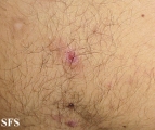 eosinophilic pustular folliculitis