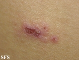 eosinophilic pustular folliculitis