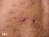 eosinophilic pustular folliculitis
