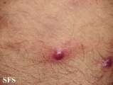 eosinophilic pustular folliculitis