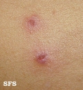 eosinophilic pustular folliculitis