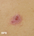 eosinophilic pustular folliculitis